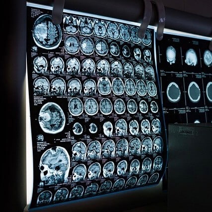 叮咚News｜分享新奇與樂趣 - 圖4 MRI適應症 腦中風及腫瘤