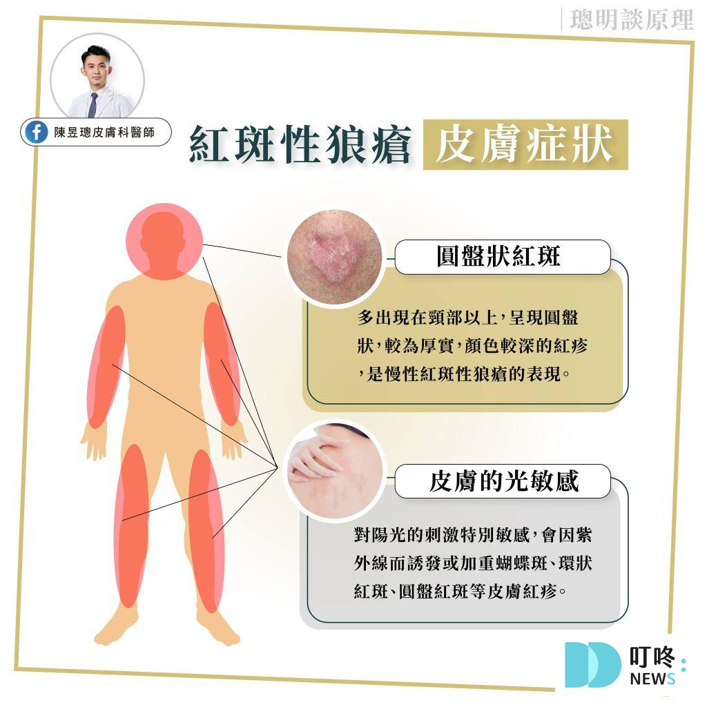 紅斑性狼瘡種類