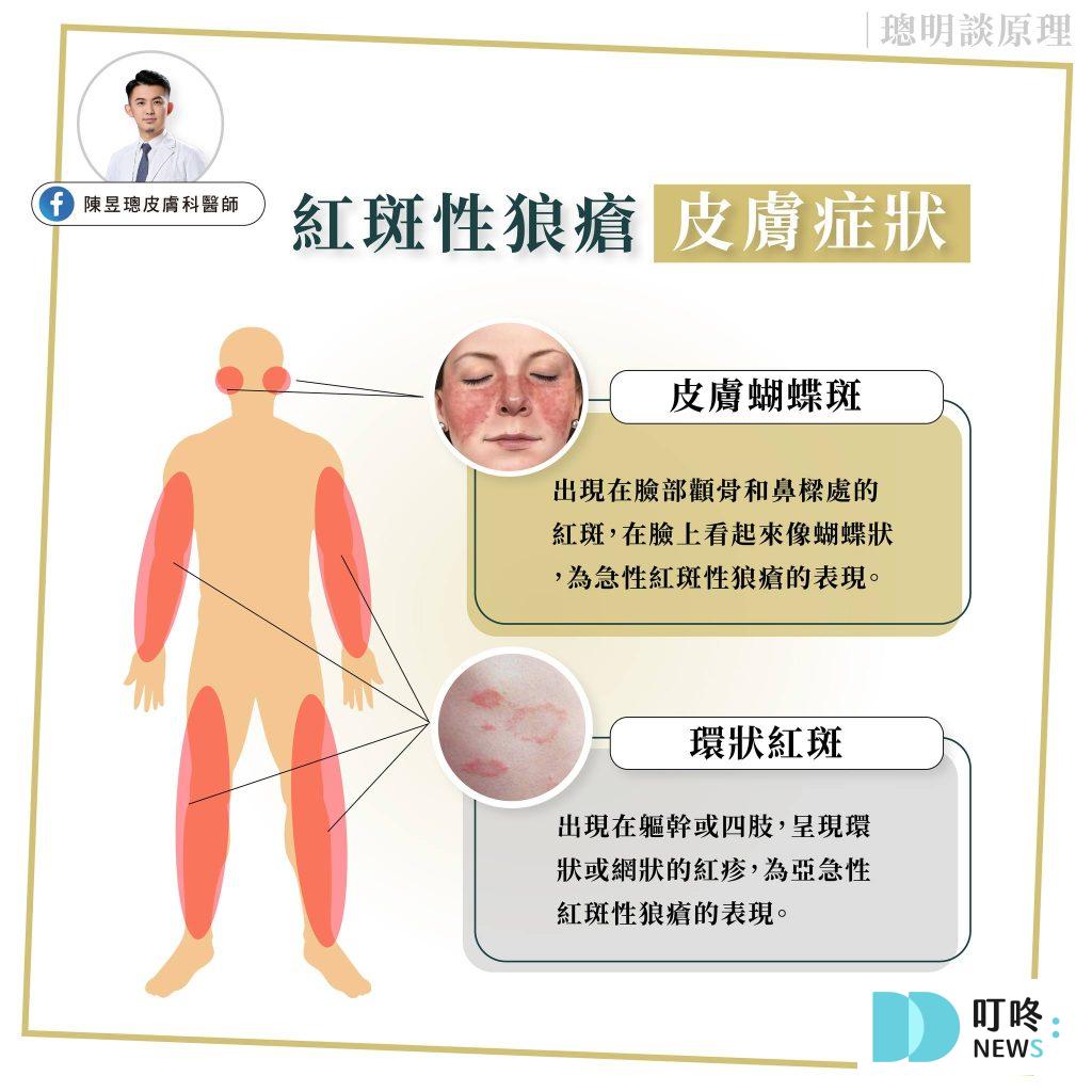 紅斑性狼瘡種類